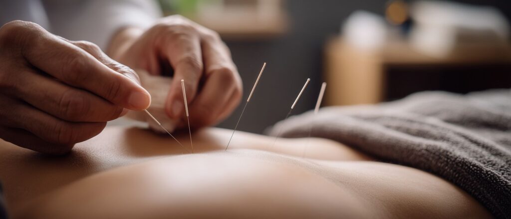 Aiguilles d’acupuncture posées sur le dos lors d’un soin de médecine chinoise